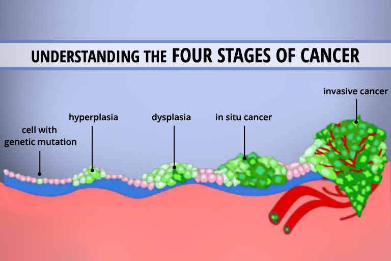 Comprendre les 4 stades du cancer