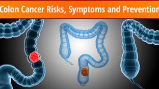 Colon Cancer Risks, Symptoms and Prevention Colon Cancer Risks, Symptoms and Prevention