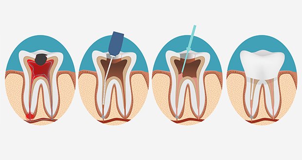 Are Root Canals a Cause of Cancer?