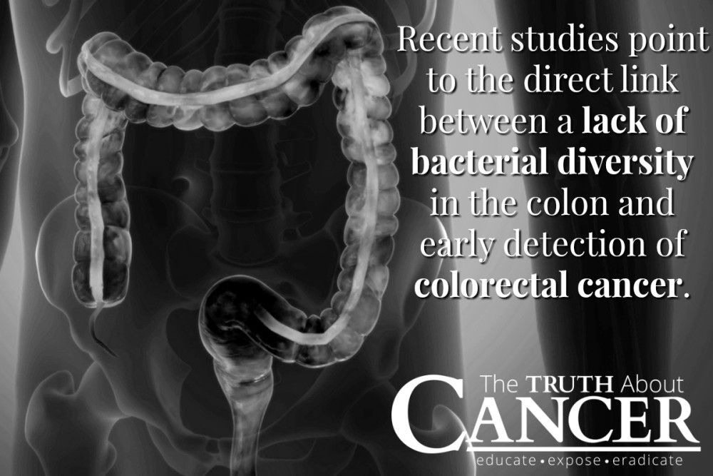 A New, NonInvasive Method for Colorectal Cancer Screening