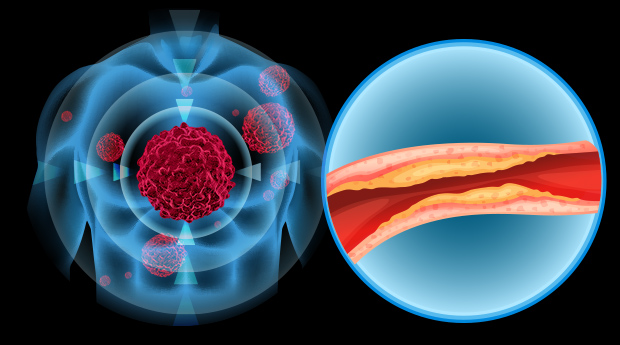 cholesterol-cancer