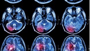 Glioblastoma: Remembering Senator John McCain Glioblastoma: Remembering Senator John McCain