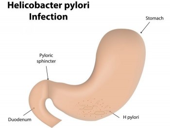h. pylori infection