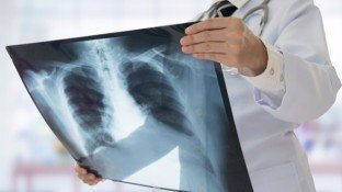Lung Cancer: Causes and Promising Natural Solutions Lung Cancer: Causes and Promising Natural Solutions