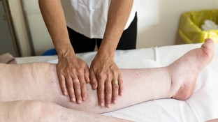 Lymphedema: Causes, Symptoms & Treatment Options Lymphedema: Causes, Symptoms & Treatment Options