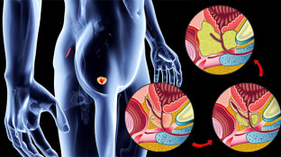 4 Early Warning Signs of Prostate Cancer: Understanding Prostate Cancer Symptoms 4 Early Warning Signs of Prostate Cancer: Understanding Prostate Cancer Symptoms